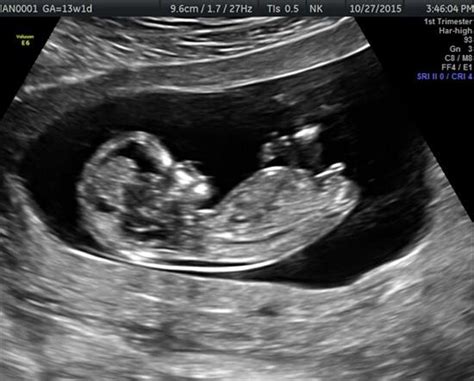 accuracy of dating ultrasound at 13 weeks